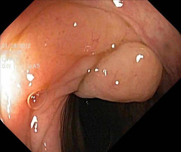 Colonoscopy image